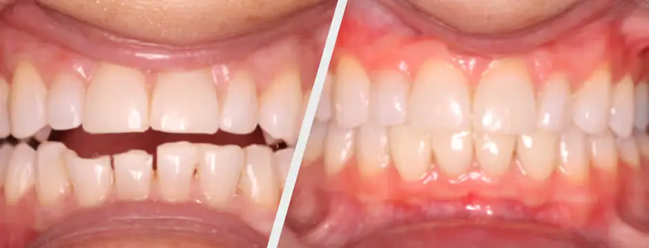 Lower Anterior Veneers<br />
