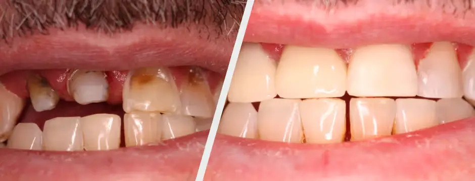 Cosmetic Resin Bonding