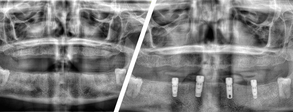Implant Overdenture Before and After