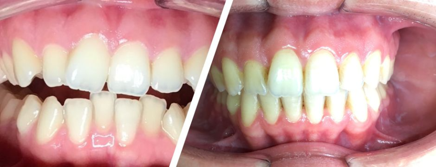 Ortho Before and After