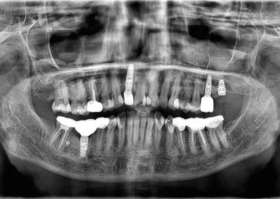 Full Mouth Rehabilitation Start