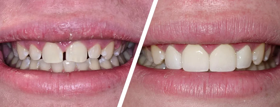 Esthetic Crowns Before and After