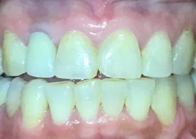 Orthodontic Finish