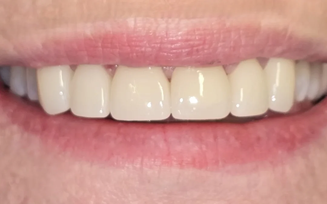 Veneers 6 Front Teeth 2025