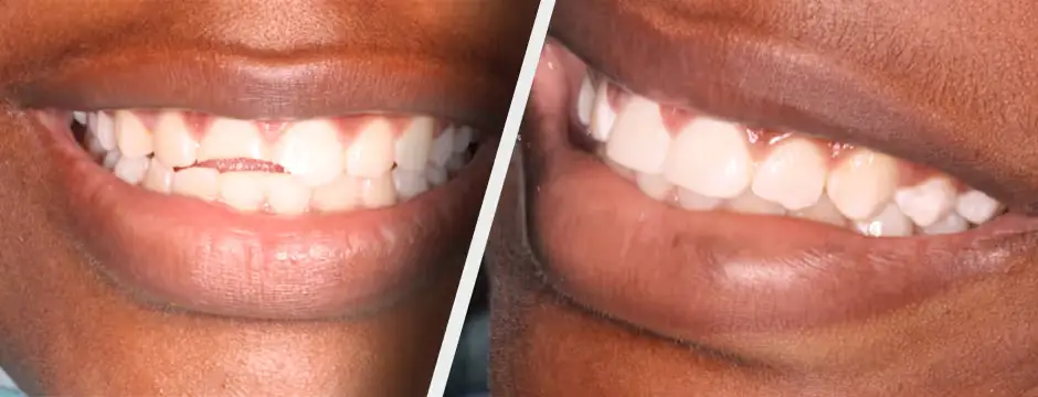 Cosmetic Resin Bonding